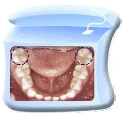 孩子长双层牙怎么回事,孩子长双层牙