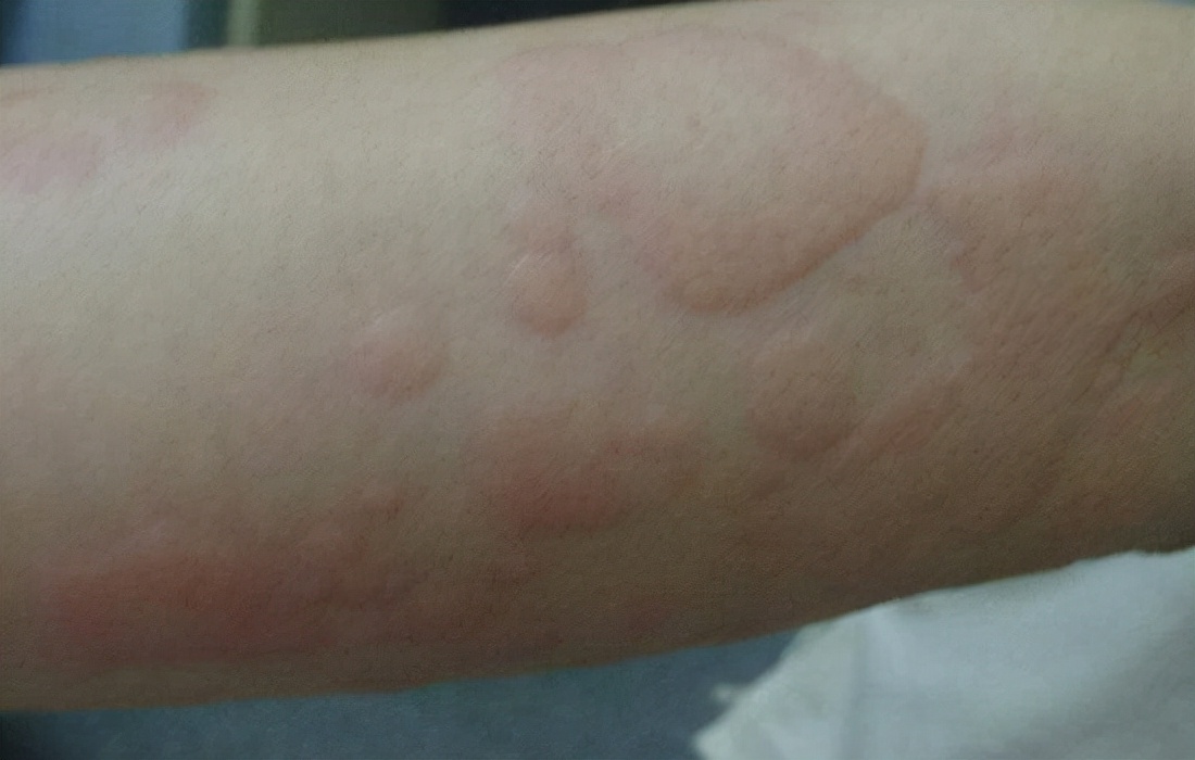 战痘的正确方法图解,五个“战痘”小妙招