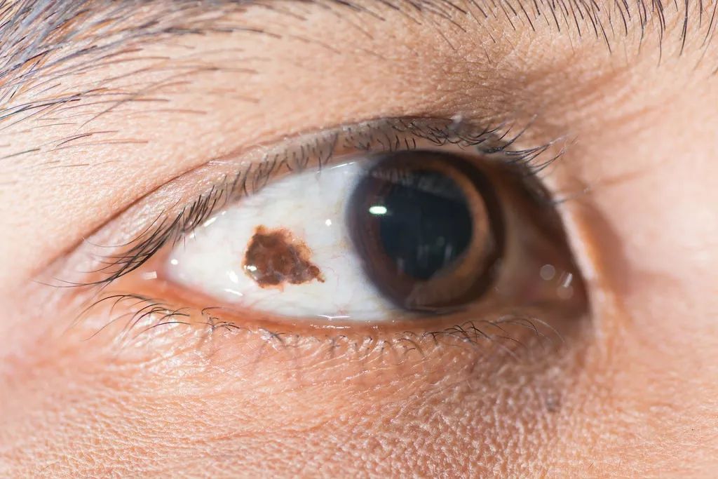 孩子眼白有小黑点是什么原因,儿童眼白有黑点是什么原因