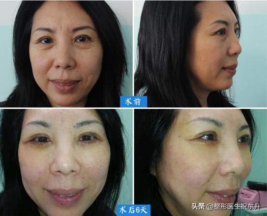 40多岁眼袋很重，还有泪沟该怎么办？听听医生怎么说...