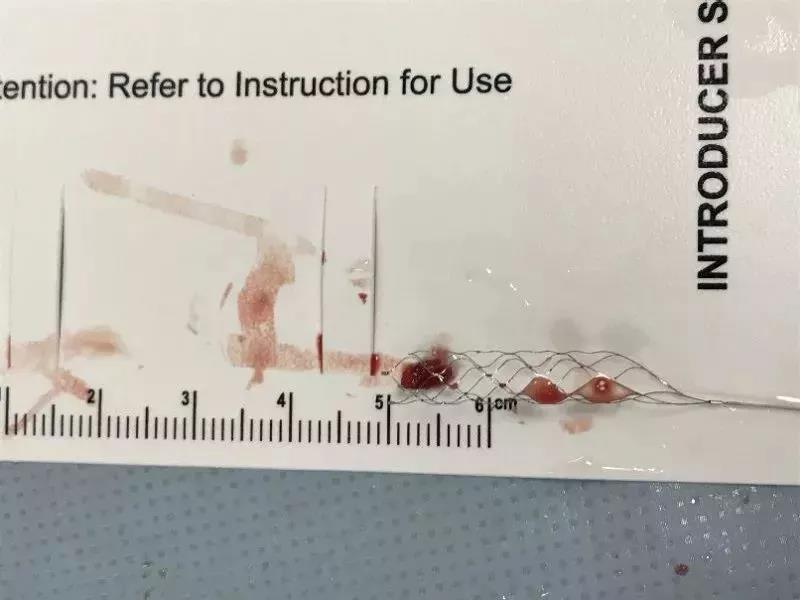 急性脑梗死后遗症的治疗,急性脑梗死保守治疗康复效果