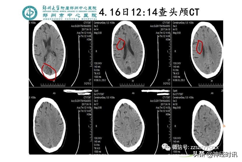 静脉溶栓怎么引起的,静脉相关并发症的预防及处理