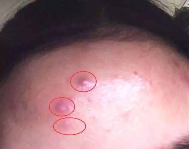 挤痘进了ICU，连下两次病危通知？这痘痘到底还能不能挤！