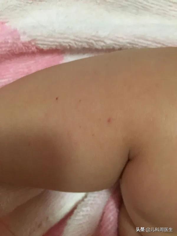 出生第二天宝宝皮下有出血点,40多天的新生儿皮下出血怎么办
