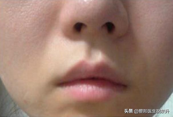 鼻翼两侧法令纹一道红沟,鼻翼两侧的法令纹有何说道