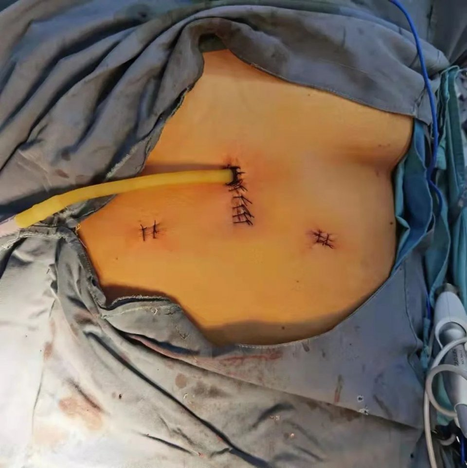 胸腔肿瘤怎么手术,肿瘤手术微创和胸腔镜手术