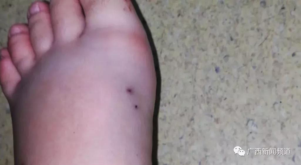 游客被毒蛇咬伤怎么处理,广西一名男子被五毒蛇咬伤