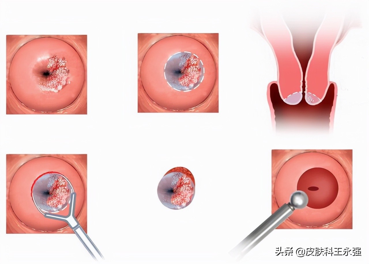 女性腹部隐痛查出宫颈癌,30岁腿痛查出宫颈癌案例