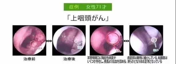 通过化疗能彻底杀死早期癌细胞吗,肿瘤免疫时代来临谁能从中获益