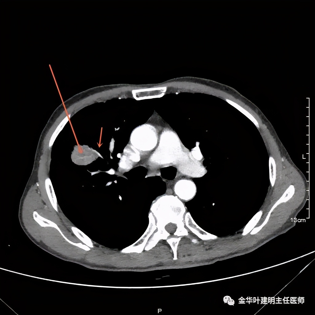 左肺占位被安排穿刺活检是肺癌吗,肺癌肺部穿刺有什么危险