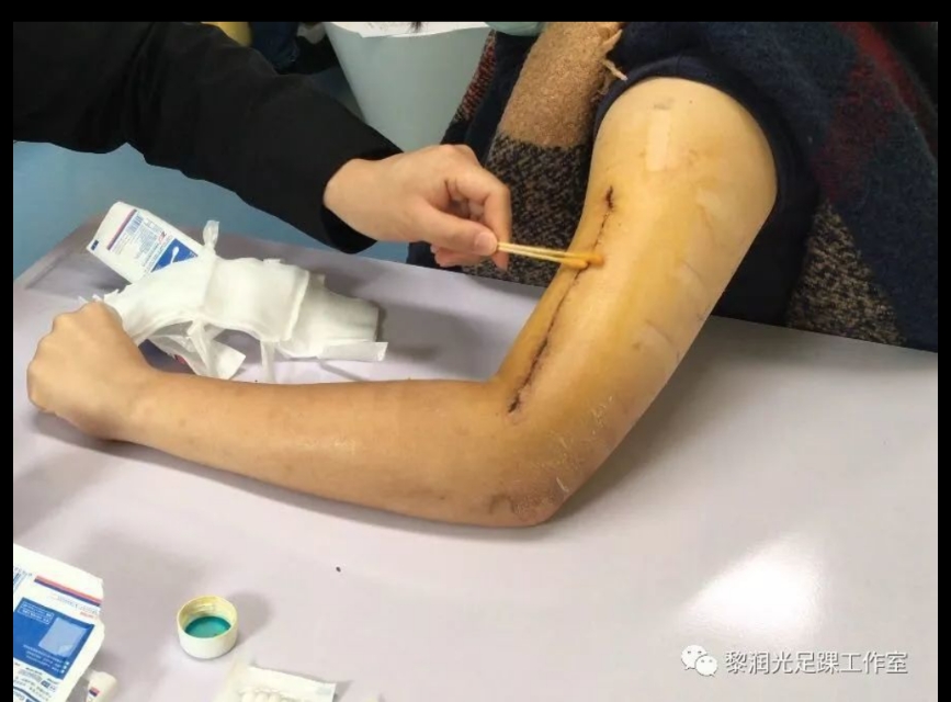 术后自己在家换药应该注意什么,医院手术后换药流程