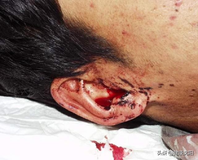 颅脑外伤治疗指南,颅脑损伤康复科普知识汇总