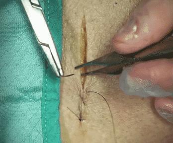 十种外科基本缝合方式详解,手术切口缝合有哪几种