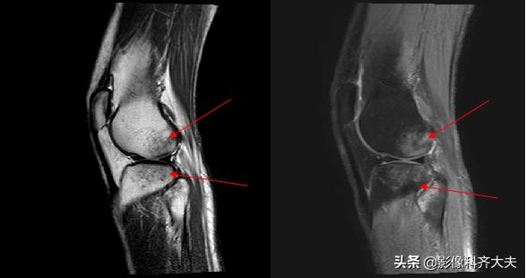 骨折的影像学检查及各自的优势,骨折的影像学愈合标准