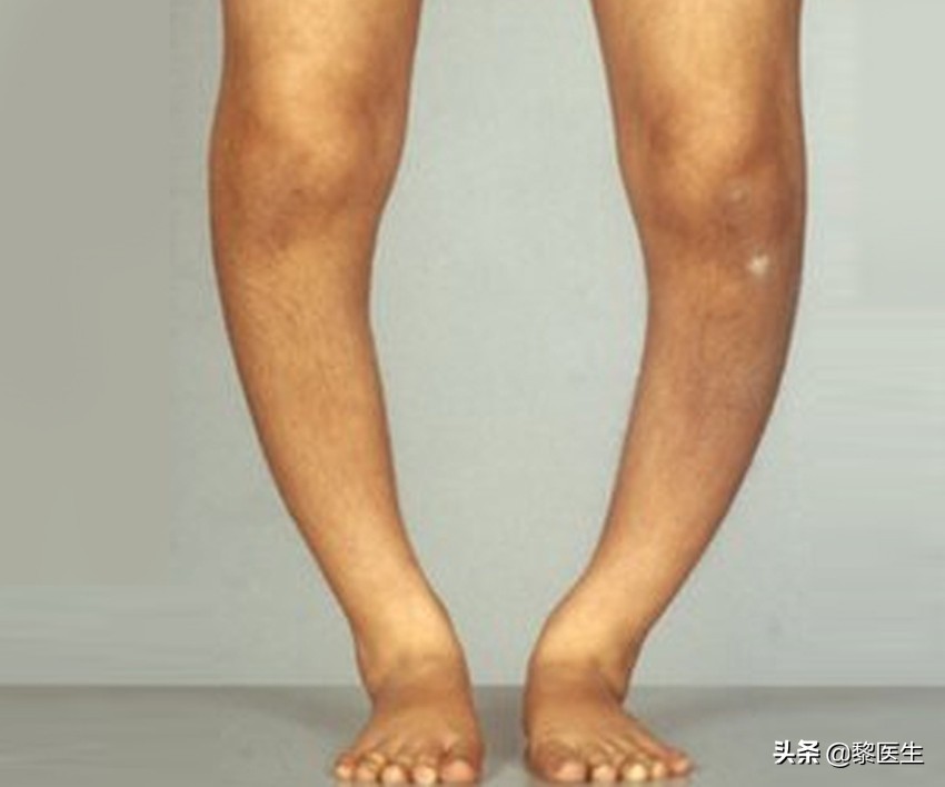 孩子佝偻病缺钙严重补钙多久见效,佝偻病是因为宝宝缺钙引起的吗