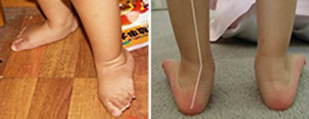 足外翻最佳治疗时间几岁,足外翻最佳治疗时间