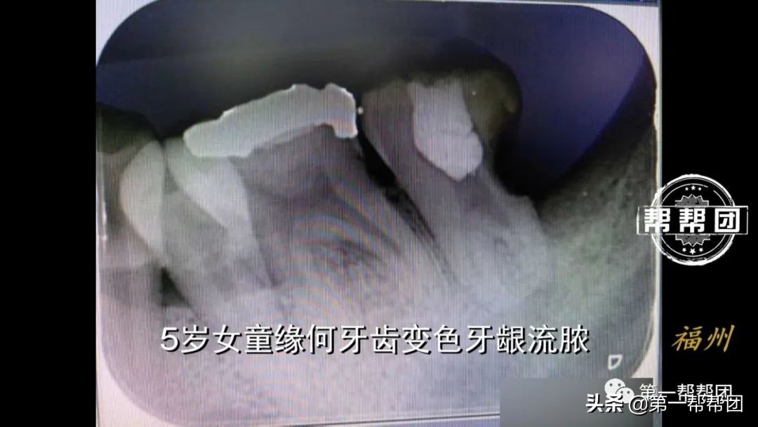 小孩牙齿烂掉牙龈有脓包,5岁女童牙龈反复化脓