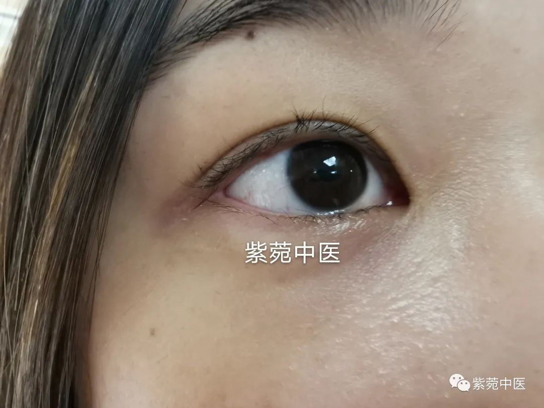 长期戴隐形眼镜、看电脑,眼睛又红又痒?医生:上甘草泻心