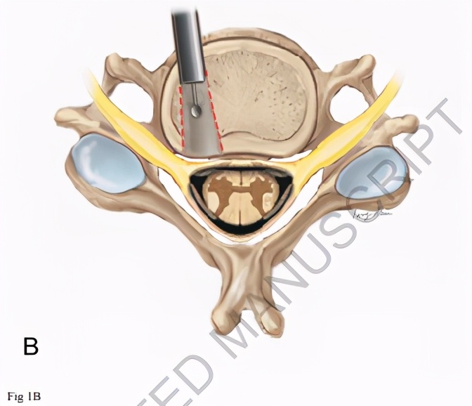 颈椎内窥镜手术效果,颈椎病内窥镜手术