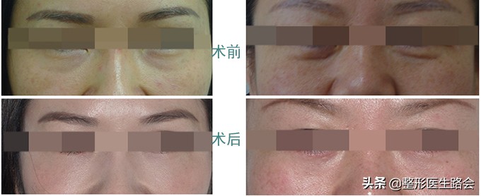 填了泪沟眼睛淤青很厉害,填完泪沟8个月了还淤青怎么办