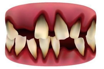 牙龈萎缩为什么不可逆,牙龈萎缩龈下刮治后萎缩更严重