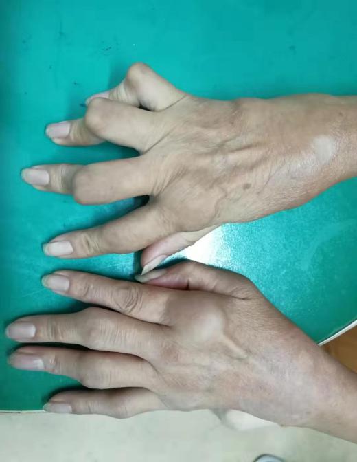 关于风湿病你了解多少,带您了解风湿病