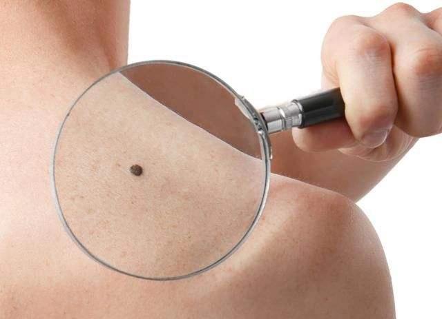 黑痣到底是什么样子,身上最可怕的黑痣