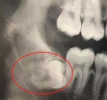 丽水小伙拔个牙住院三天、暴瘦10斤、脸肿成“方形”！这两类人赶紧检查一下
