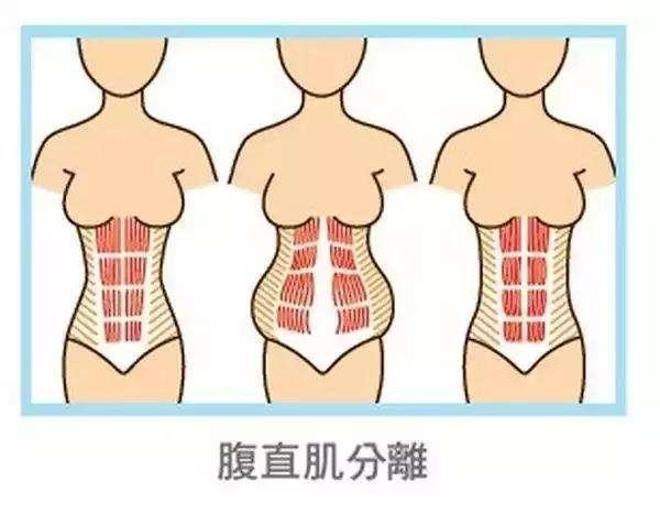 产后多久是腹直肌修复的最佳时间,产后腹直肌修复什么时候能做