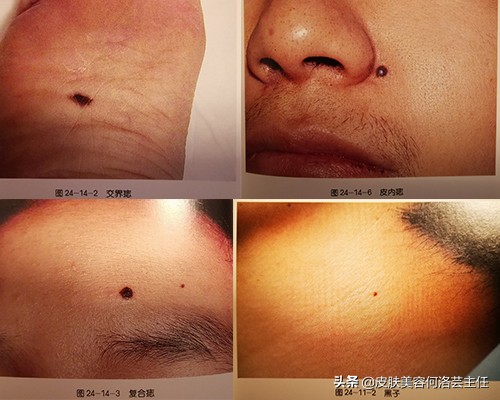 为什么色素痣会越来越多,有无色素痣都要注意什么