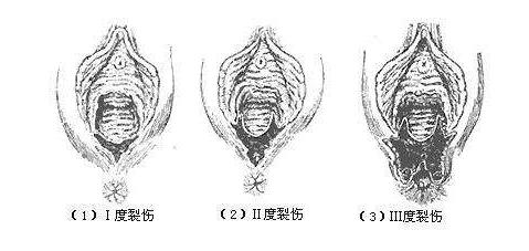 软产道损伤是什么,了解这些