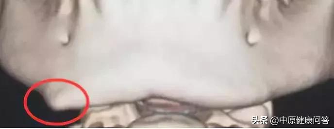 小下颌畸形后长大的孩子,下颌畸形能导致什么病