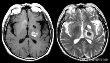 脑出血磁共振各个时期表现,脑出血的分期及磁共振影像学表现