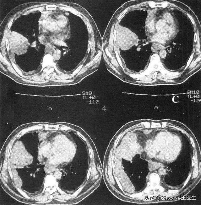 男性阴茎癌病前征兆,阴茎癌青年发病率