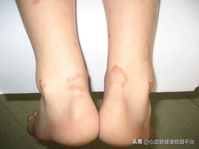 闃垮杸鐞夋柉涔嬭傅鏄笉鏄窡鑵辩値,闃垮杸鐞夋柉涔嬭傅鏄窡鑵辨柇瑁備箞