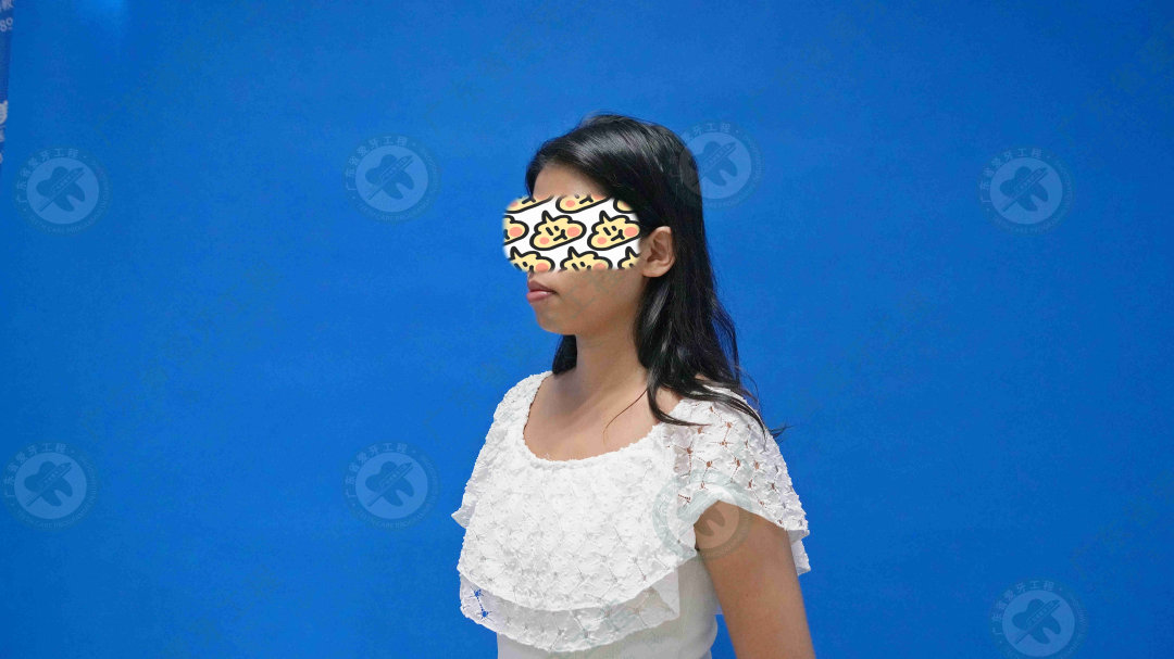 骨性龅牙凸嘴正颌手术全过程,29岁女生稍微骨性龅牙怎么矫正