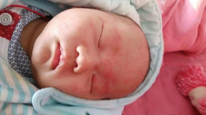 请月嫂孩子也能起湿疹,月嫂给婴儿捂出湿疹怎么办