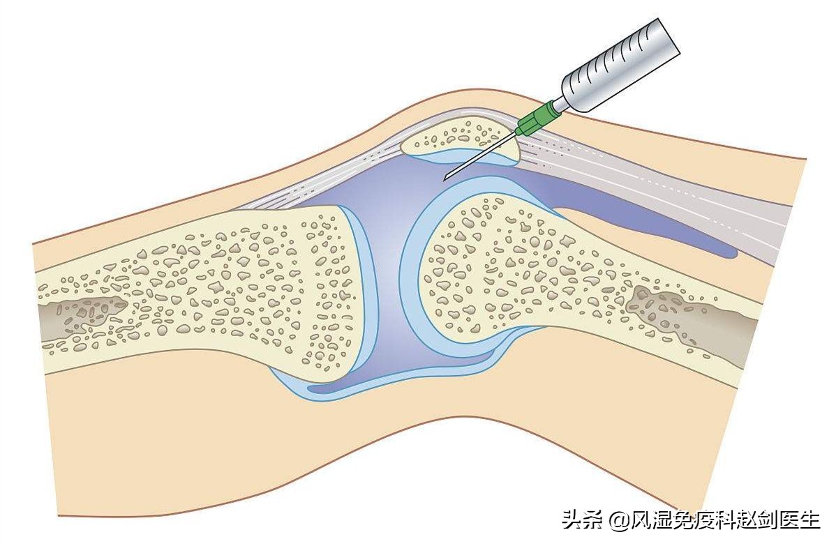 骨关节炎吃药可以做理疗吗,退化性骨关节炎需要终身服药吗