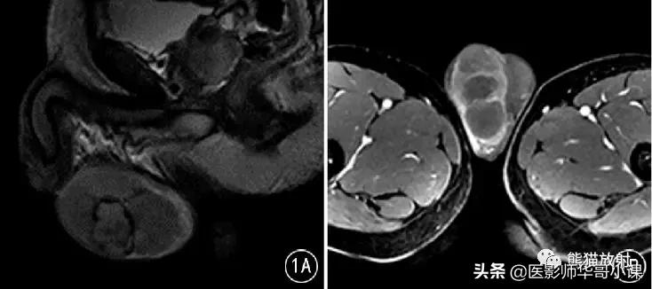 [精品课件]畸胎瘤及精原细胞瘤（*丸睾**肿瘤及肿瘤样变CT及MR表现）