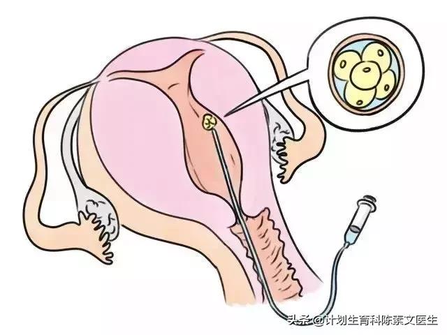 宫外孕可以用试纸测出来怀孕吗,卵巢宫外孕后再次怀孕几率大吗