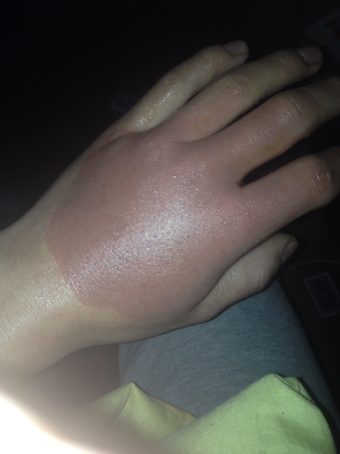 做饭被油溅伤脸怎么处理,手烫伤后能做家务吗