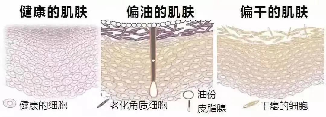 水油不平衡毛孔粗大用什么护肤品,水油不平衡的表现