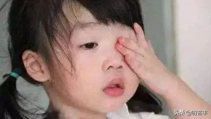 眼睛过敏性结膜炎,结膜炎可以热敷吗