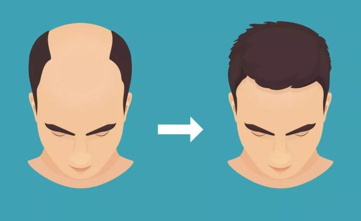 秃顶这件事就过不去了?两项新研究为治疗脱发带来新希望