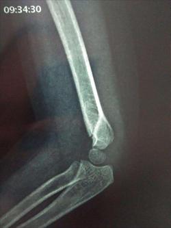 儿童轻微骨折恢复最佳的方法,骨科姚大夫的视频