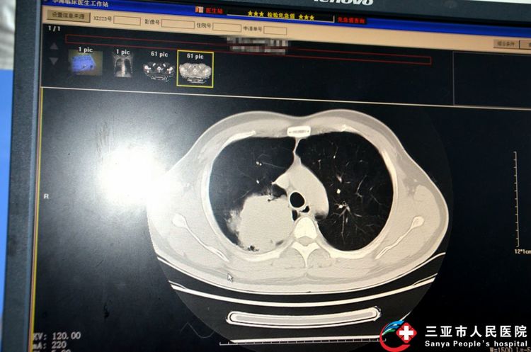 新技术作内核精诚服务患者——三亚市人民医院呼吸内科医疗团队成功开展我省首例支气管镜下冷冻活检术