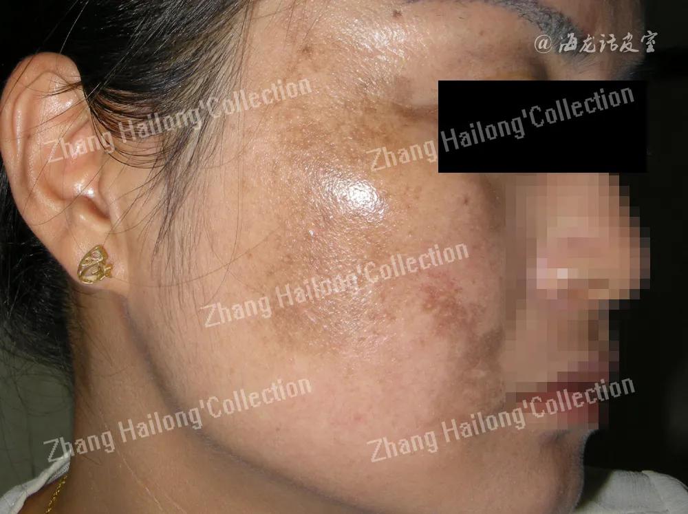 褐斑怎么办,褐斑能彻底去除吗