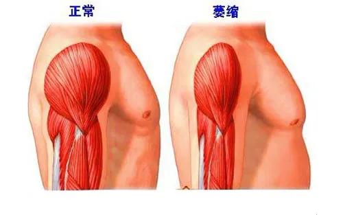 进行性肌营养不良跟渐冻症的区别,进行性肌营养不良症与渐冻症