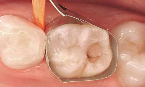 8岁儿童乳牙蛀牙需要治疗吗,五岁孩子蛀牙了需要补吗