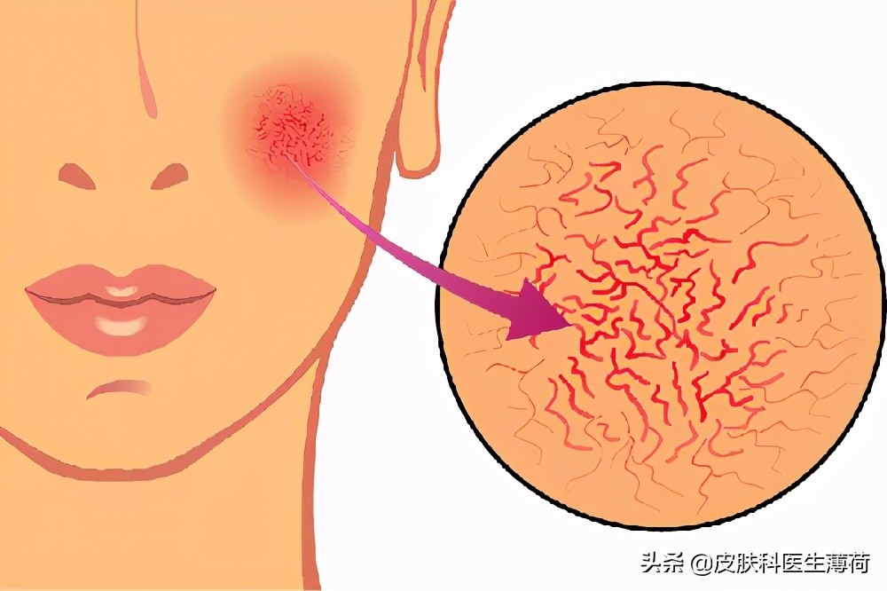 皮肤科医生教你如何处理痘印,医院的皮肤科主治痘痘痘印吗